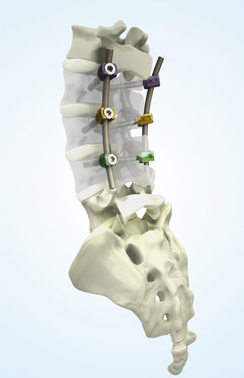 Osteo-Fix  Spinal System 