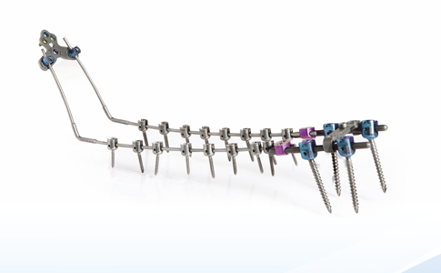 Posterior Cervicothoracic Fixation System  