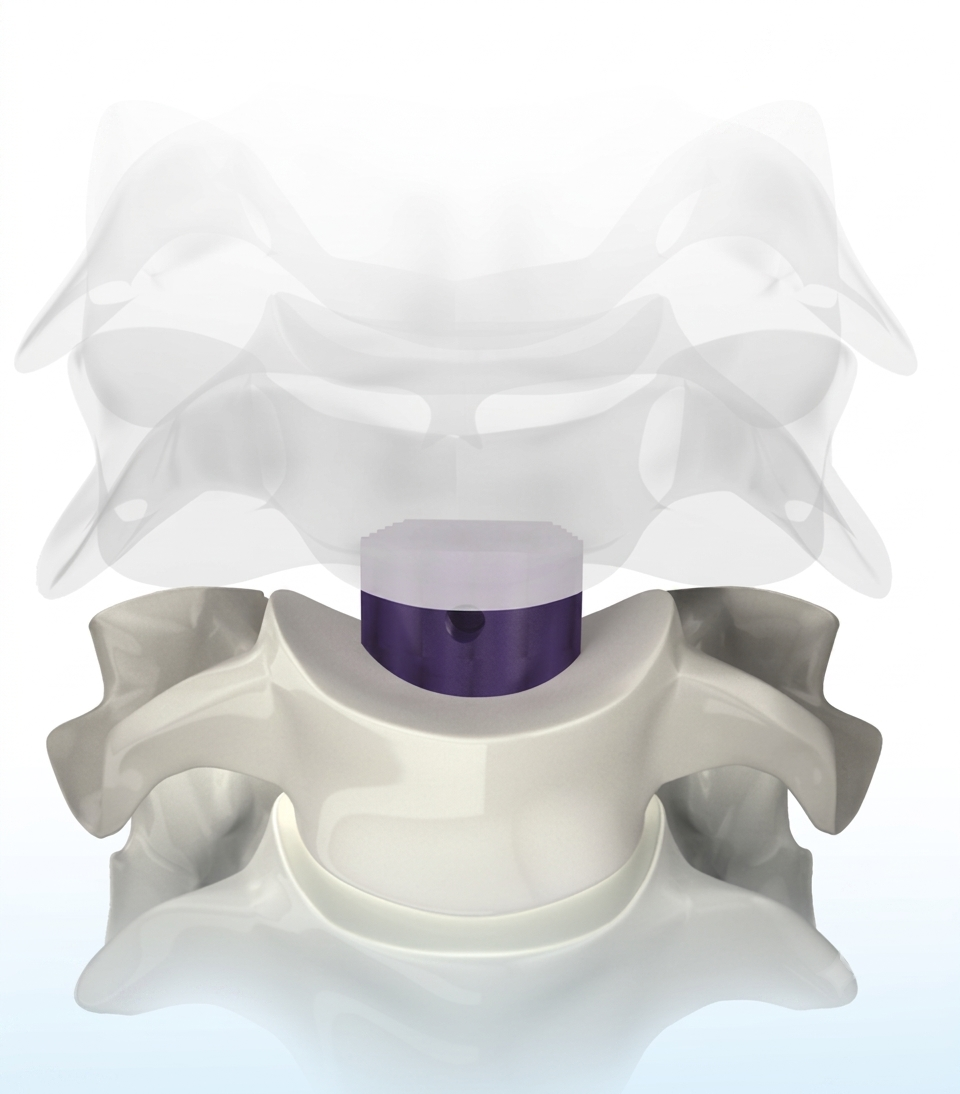  Anterior Cervical Disc Spacer